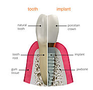 Dental Implant Dubai