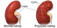 Kidney Disease - Kidney Treatment - Beat Kidney Disease
