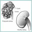 Polycystic Kidney Disease Treatment Options Customer Reviews and Ratings