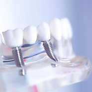 What are the advantages and disadvantages of dental implants?