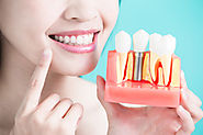 Root canal as an alternative to tooth loss