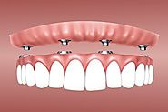 Why To Consider The Dental Implant?