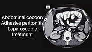 Abdominal cocoon Adhesive peritonitis Laparoscopic treatment
