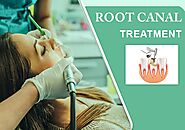 Root Canal Treatment RCT In Hyderabad