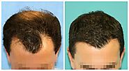 The Best Hair Transplant option available in Pakistan - Vigyaa