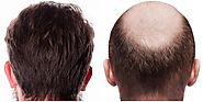 Have you been Reluctant due to Unfamiliarity with the Hair Transplant Cost in Lahore? – Health Garage