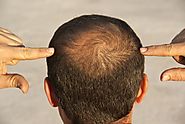 If you are a Karachite and looking for a Good Hair Replacement in Karachi, here's what you should know | 1st Health R...