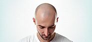 If you need a Non-Surgical Hair Transplant, here’s what you should know – The Health Vision