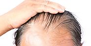 “Where can I get the standard hair transplant cost in Pakistan? “Is that what you are thinking? – 1st Health Now