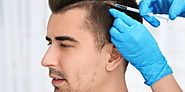 How FUE Hair Transplant can be Beneficial for you? – Idea Health
