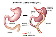 Roux-en-Y Gastric Bypass Stomach Weight Loss Surgery