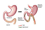 Mini Gastric Bypass (MGB) Metabolic Bariatric Surgery Procedure