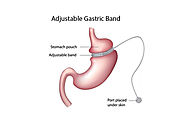 Laparoscopic Adjustable Gastric Banding Weight Loss Surgery