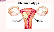 Uterine Polyps-important Things To Keep In Mind