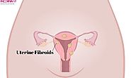Uterine Fibroids-Related Information To Be Acquainted With