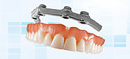 Dental Implant Bar Overdenture, Hybrid Overdentures NJ | Bio-Dent Laboratories