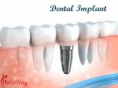 Dental implants in Los Algodones
