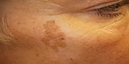 7 Home Remedies To Treat liver Spots - Sarah Asks