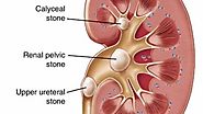 Few Efficient Tips to Dissolve Kidney Stones Naturally