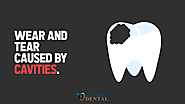 • Wear and tear caused by cavities