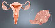 Your Health Solutions: Polycystic Ovary Syndrome (PCOS)