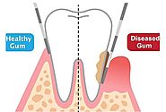 Chronic Gum Disease Needs Immediate Treatment to Avoid Loss of Teeth