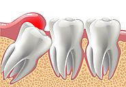 How much the Wisdom Teeth Removal Cost?