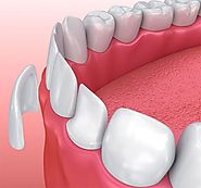 Keep your teeth healthy with the finest Wisdom Tooth Dentists in Melbourne