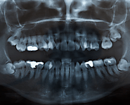 Removal of Impacted Cyst Wisdom Teeth: What Are They and How They Can Be Prevented?