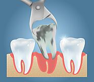Get Best Wisdom Tooth Extraction Service at Melbourne