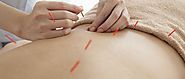 Five Reasons to Get Acupuncture for Low Back Pain - Edgar Family Chiropractic