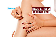 How to get rid of ingrown hair quickly with 6 natural Ways | How to Cure