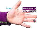 How to Get Rid of a Blood Blister Using Natural Ways| How to Cure