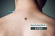 How to get rid of a cyst in 5 quick ways at home naturally | How to Cure