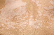 Tiversical: The Ultimate Tinea Versicolor Herbal Supplement - Natural Health News