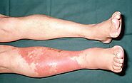 Cellulitis Infection: Warning Signs You Should Never Ignore