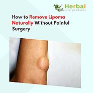 How to Remove Lipoma Naturally Without Painful Surgery - Herbal Care Products - Blog