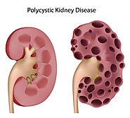 What Natural Treatments for Reversing Polycystic Kidney Disease - Herbal Care Products - Blog