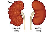 Most 12 Deadly Symptoms Of Kidney Diseases You Shouldnt Ignore - Herbal Care Products - Blog