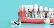 Extensive Clinical Provisions on Dental Implants