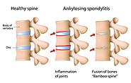 Best Homeopathic Doctor & treatment for Ankylosing Spondylitis in India