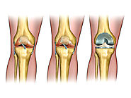 Total Joint Replacement Surgeon in Delhi NCR