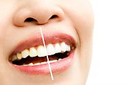 Teeth Cleaning Treatment Noida | Kaashvi Medident | Dr. Shalini Jain