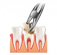Painless Tooth Extraction Treatment Noida | Kaashvi Medident | Dr. Shalini Jain