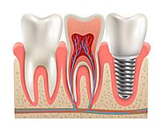Dental Implant in Noida | Kaashvi Medident | Dr. Shalini Jain