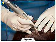 SUT hair transplantation in Iran , What is this method? - ir Persiatour