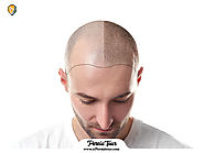 FUE hair transplantation in Iran , What is this technique? - ir Persiatour