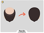 What is Micro Fit hair transplantation? - ir Persiatour