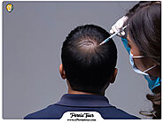 What is the FIT hair transplantation method? - ir Persiatour