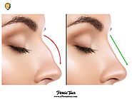 What is the reason everyone recommend to do nose job in Iran?